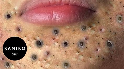 why is blackhead removal satisfying|Why Some People Enjoy Watching Pimple Popping Videos.